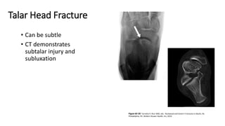 Ct Ricchi LE F&A4 Fractures and Dislocation of the Talus.pdf