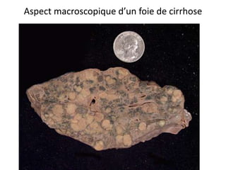 Aspect macroscopique d’un foie de cirrhose
 