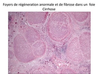 Foyers de régéneration anormale et de fibrose dans un foie
                         Cirrhose
 