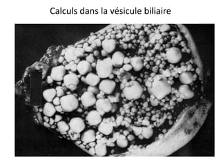 Calculs dans la vésicule biliaire
 