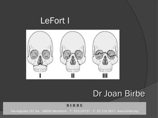 LeFort I
Dr Joan BirbeDr Joan Birbe
B I R B E
Vía Augusta 101 bis . 08006 Barcelona . T: 932124737 . F: 93 218 0817. www.birbe.org
 