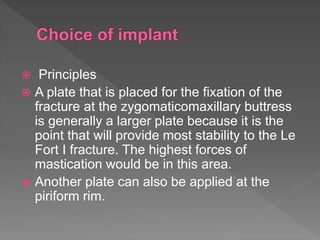  Principles
 A plate that is placed for the fixation of the
fracture at the zygomaticomaxillary buttress
is generally a larger plate because it is the
point that will provide most stability to the Le
Fort I fracture. The highest forces of
mastication would be in this area.
 Another plate can also be applied at the
piriform rim.
 
