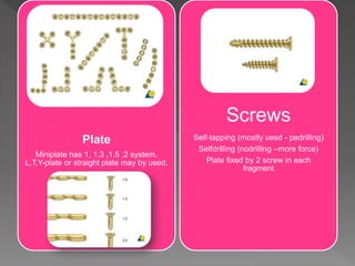 Plate
Miniplate has 1, 1.3 ,1.5 ,2 system.
L,T,Y-plate or straight plate may by used.
Screws
Self-tapping (mostly uesd - pedrilling)
Selfdrilling (nodrilling –more force)
Plate fixed by 2 screw in each
fragment
 