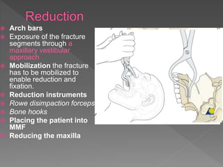  Arch bars
 Exposure of the fracture
segments through a
maxillary vestibular
approach
 Mobilization the fracture
has to be mobilized to
enable reduction and
fixation.
 Reduction instruments
 Rowe disimpaction forceps
 Bone hooks
 Placing the patient into
MMF
 Reducing the maxilla
 