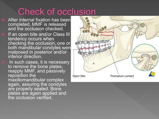  After internal fixation has been
completed, MMF is released
and the occlusion checked.
 If an open bite and/or Class III
tendency occurs when
checking the occlusion, one or
both mandibular condyles were
malposed in posterior and/or
inferior direction.
 In such cases, it is necessary
to remove the bone plates,
reapply MMF, and passively
reposition the
maxillomandibular complex
again, assuring the condyles
are properly seated. Bone
plates are again applied and
the occlusion verified.
 
