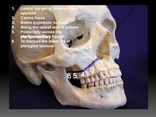 1. Lateral margin of anterior nasal
aperture
2. Canine fossa
3. Below zygomatic buttress
4. Along the lateral wall of anturm
5. Posteriorly across the
fissure
6. To fracture the lower 1/3 of
pterygiod laminae
 