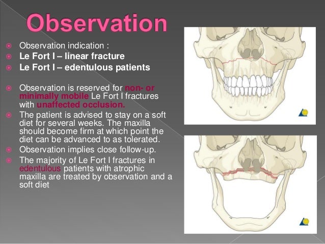 lefort fracture
