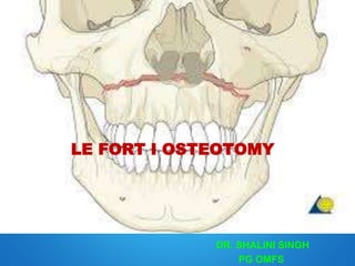 LE FORT I OSTEOTOMY
DR. SHALINI SINGH
PG OMFS
 