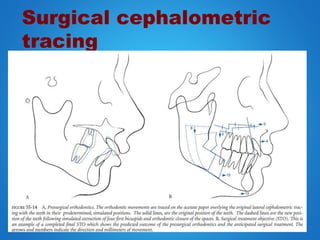 Surgical cephalometric
tracing
 