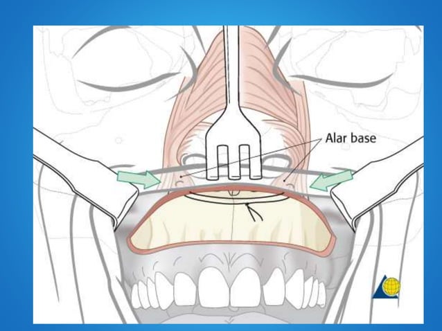 lefort-1-osteotomy-pptx-bone-and-joint-conditions-diseases-and