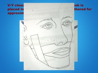 V-Y closure of a lip incision. A skin hook is
placed in the midline and tissue is gathered for
approximately 1 cm with suture
 