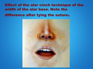 Effect of the alar cinch technique of the
width of the alar base. Note the
difference after tying the suture.
 