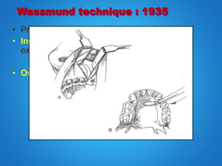 • Preserves both buccal & palatal soft tissues.
• Incision : vertical incision – planned
extraction or interdental osteotomy.
Anterior nasal spine incision.
• Osteotomy : buccal horizontal osteotomy
transpalatal osteotomy
repositioning of entire segment.
Wassmund technique : 1935
 