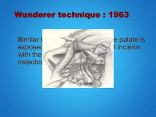 Wunderer technique : 1963
Similar to wassmund, except the palate is
exposed by a transverse palatal incision
with the margins away from the
osteotomy site.
 