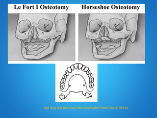 Oral Surg Oral Med Oral Pathol Oral Radiol Endod 2004;97:683-92
 