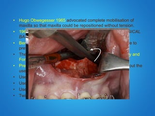 • Hugo Obwegesser 1965 advocated complete mobilisation of
maxilla so that maxilla could be repositioned without tension.
• 1969-75 Bell, Lefort I downfracture & formed the BIOLOGICAL
BASIS
• Bennett & Wolford (1985) described cutts Parallel FH plane to
prevent ramping effect.
• The correct used of curved osteotome described by Turvey and
Fonseca in 1980
• Precious et al described pterygomaxillary dysjunction without the
use of osteotome (1991)
• Use of Swan neck osteotome by cheng ( 1993)
• Use of Saw by cheng (1993)
• Use of Shark Fin osteotome by laster (2002)
• Twist technique by fredricko (2012)
 