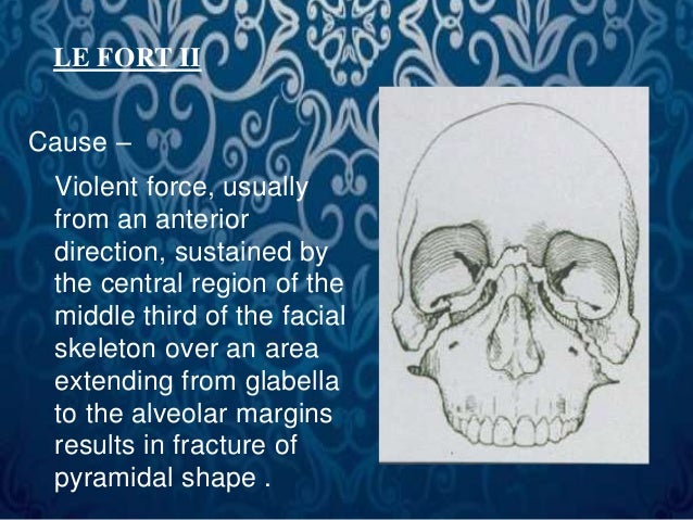 Le fort fracture by Dr. Amit T. Suryawanshi, Oral Surgeon ...