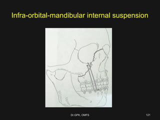 Infra-orbital-mandibular internal suspension
Dr.GPK, OMFSDr.GPK, OMFS 121121
 
