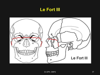 Le fort fractures | PPT