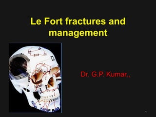 Le Fort fractures and
management
Dr. G.P. Kumar.,Dr. G.P. Kumar.,
11
 