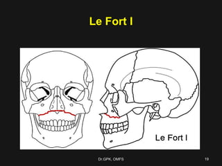 Le fort fractures | PPT