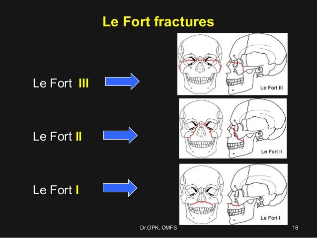 le fort fracture le fort fracture