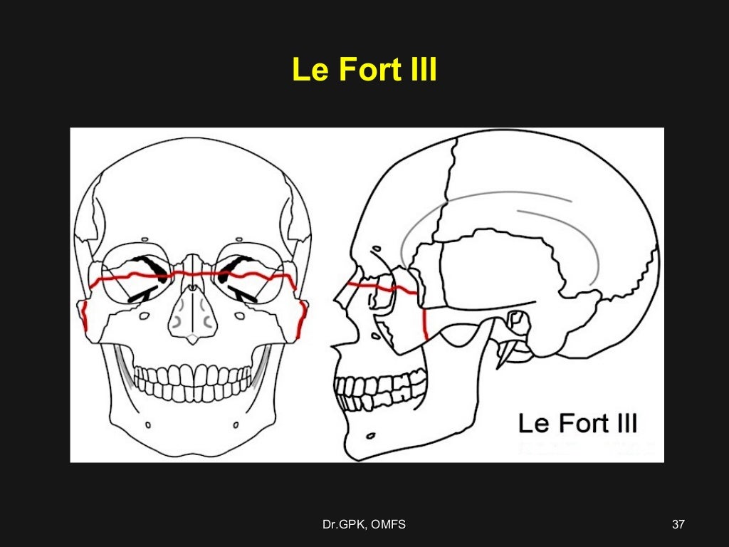Le fort fractures
