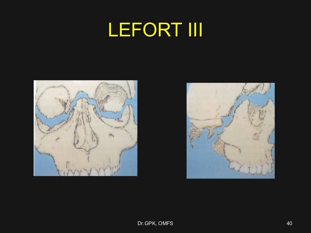 causes of a le fort fracture causes of a le fort fracture