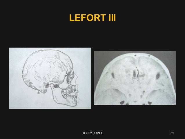 Lefort Fracture Repair