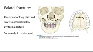 Sub Pypriform Sea Shell LE FORT FRACTURES AND THEIR MANAGEMENT.pptx