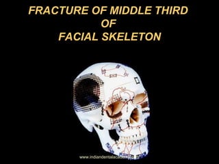 FRACTURE OF MIDDLE THIRD
OF
FACIAL SKELETON

www.indiandentalacademy.com

 