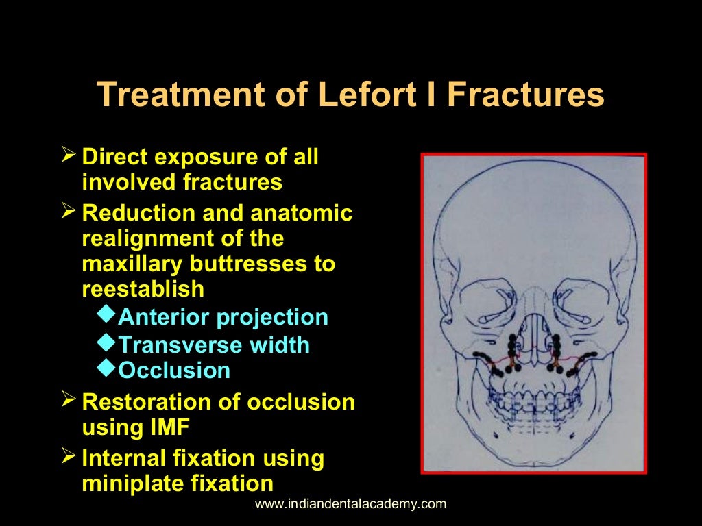 Lefort fractures /certified fixed orthodontic courses by Indian denta…