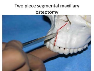 Le fort i maxillary osteotomy