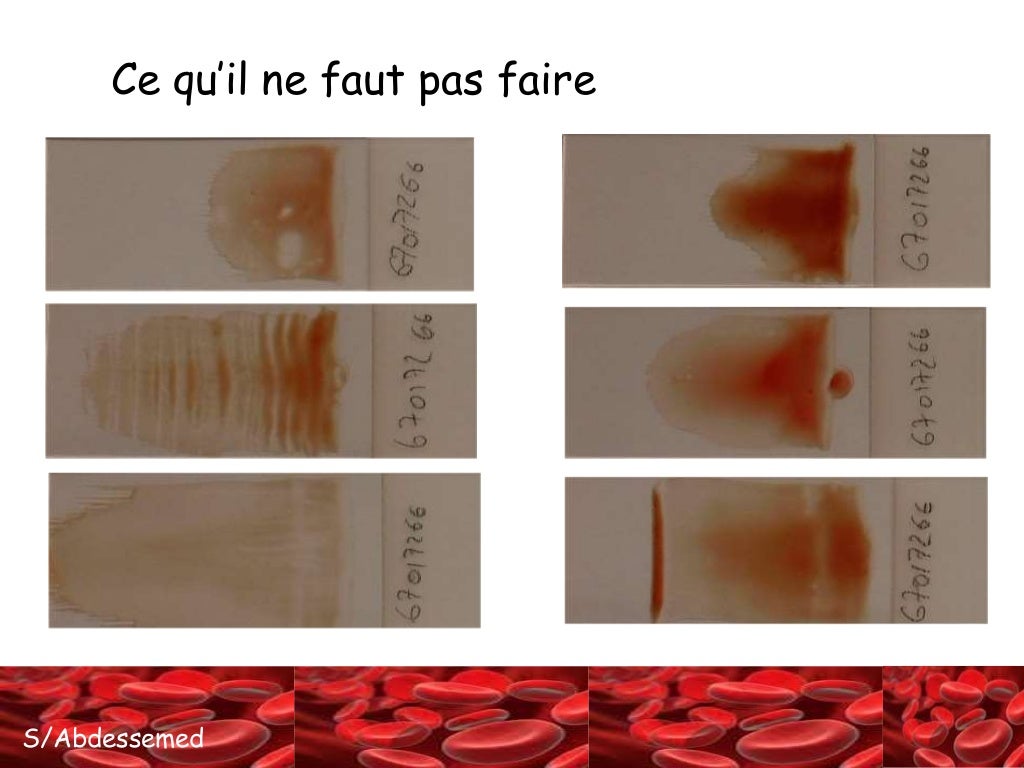 La confection du frottis sanguin.