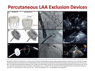 Percutaneous LAA Exclusion Devices
 