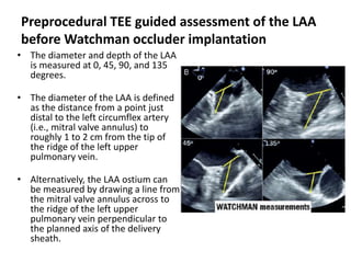 Preprocedural TEE guided assessment of the LAA
before Watchman occluder implantation
• The diameter and depth of the LAA
is measured at 0, 45, 90, and 135
degrees.
• The diameter of the LAA is defined
as the distance from a point just
distal to the left circumflex artery
(i.e., mitral valve annulus) to
roughly 1 to 2 cm from the tip of
the ridge of the left upper
pulmonary vein.
• Alternatively, the LAA ostium can
be measured by drawing a line from
the mitral valve annulus across to
the ridge of the left upper
pulmonary vein perpendicular to
the planned axis of the delivery
sheath.
 