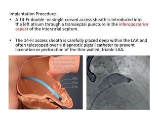 Implantation Procedure
• A 14-Fr double- or single-curved access sheath is introduced into
the left atrium through a transseptal puncture in the inferoposterior
aspect of the interatrial septum.
• The 14-Fr access sheath is carefully placed deep within the LAA and
often telescoped over a diagnostic pigtail catheter to prevent
laceration or perforation of the thin-walled, friable LAA.
 