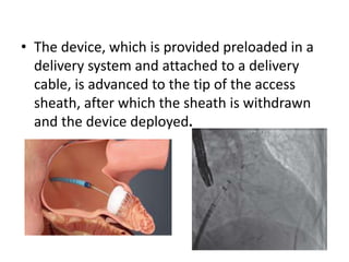 • The device, which is provided preloaded in a
delivery system and attached to a delivery
cable, is advanced to the tip of the access
sheath, after which the sheath is withdrawn
and the device deployed.
 