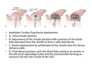 • Amplatzer Cardiac Plug device deployment.
• A- Initial sheath position.
• B- Adjustment of the sheath position with a portion of the distal
lobe extruded from the sheath to form a safe, ball-like tip.
• C- Device deployment by withdrawal of the sheath over the device
delivery cable.
• D- Final device position, with the distal lobe acting as an anchor in
the left atrial appendage (LAA) and the proximal disk forming an
occlusive lid over the mouth of the LAA.
 