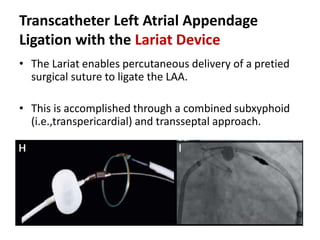 Transcatheter Left Atrial Appendage
Ligation with the Lariat Device
• The Lariat enables percutaneous delivery of a pretied
surgical suture to ligate the LAA.
• This is accomplished through a combined subxyphoid
(i.e.,transpericardial) and transseptal approach.
 