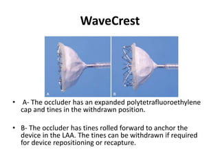 WaveCrest
• A- The occluder has an expanded polytetrafluoroethylene
cap and tines in the withdrawn position.
• B- The occluder has tines rolled forward to anchor the
device in the LAA. The tines can be withdrawn if required
for device repositioning or recapture.
 