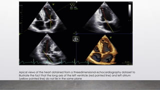 Apical views of the heart obtained from a threedimensional echocardiography dataset to
illustrate the fact that the long axis of the left ventricle (red pointed line) and left atrium
(yellow pointed line) do not lie in the same plane
 
