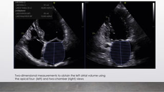 Two-dimensional measurements to obtain the left atrial volume using
the apical four- (left) and two-chamber (right) views
 