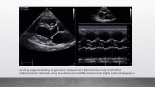 Leading edge-to-leading edge linear measurement (dotted blue line) of left atrial
anteroposterior diameter using two-dimensional (left) and M-mode (right) echocardiography
 