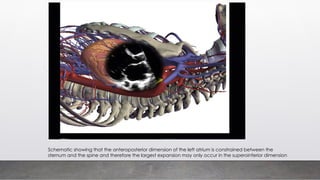 Schematic showing that the anteroposterior dimension of the left atrium is constrained between the
sternum and the spine and therefore the largest expansion may only occur in the superoinferior dimension
 