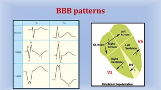 Left Bundle Branch Block (LBBB) | PPTX
