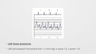 • Left heart pressures.
• Left atrium(each horizontal line = 2 mm Hg): a wave 13, v wave= 16.
 