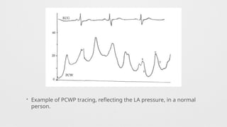 • Example of PCWP tracing, reflecting the LA pressure, in a normal
person.
 