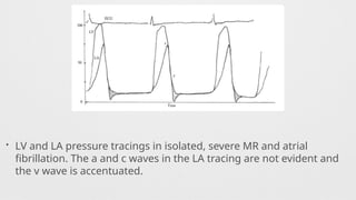 • LV and LA pressure tracings in isolated, severe MR and atrial
fibrillation. The a and c waves in the LA tracing are not evident and
the v wave is accentuated.
 