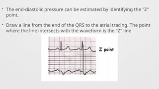 • The end-diastolic pressure can be estimated by identifying the "Z"
point.
• Draw a line from the end of the QRS to the atrial tracing. The point
where the line intersects with the waveform is the "Z" line
 